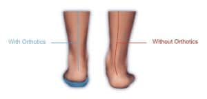 orthotics-correct-alignment