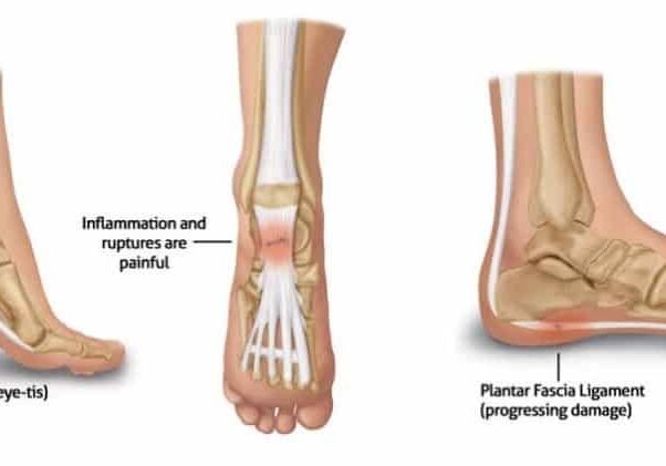 Plantar-Fasciitis